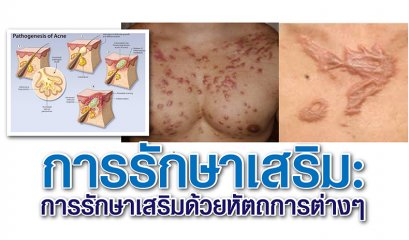 การรักษาเสริม: การรักษาเสริมด้วยหัตถการต่างๆ